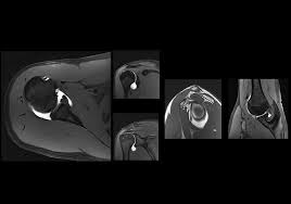 ام آر آرتروگرافی (MR Arthrography) چیست؟