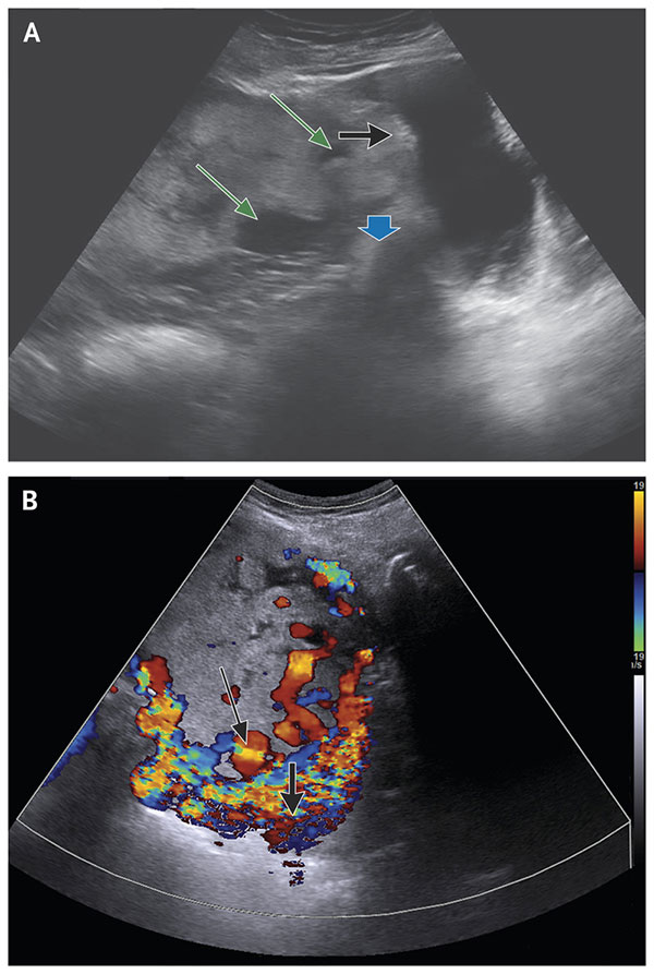نوبت دهی ام آر آی جفت در بارداری