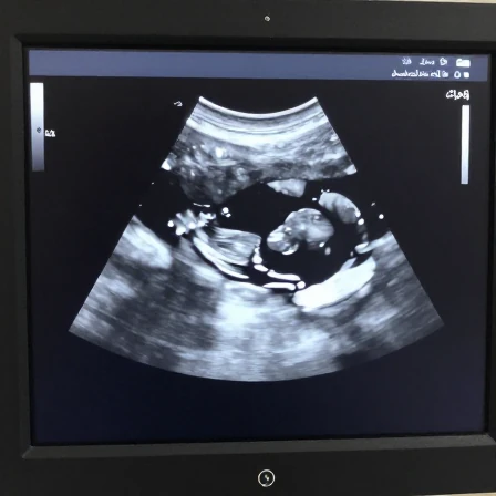 سونوگرافی جنسیت