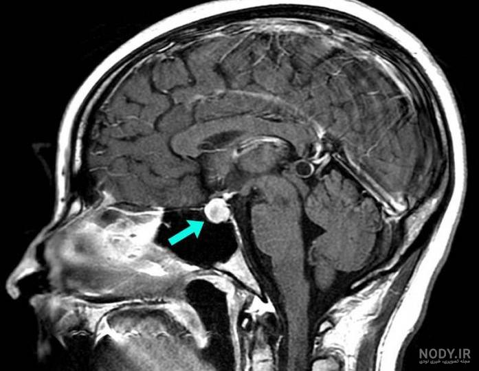 نوبت دهی ام آر آی هیپوفیز (مغز) با تزریق چگونه است و چرا انجام میشود؟